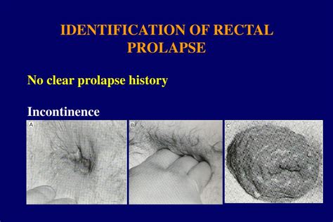 prolapsus gay|Rectal